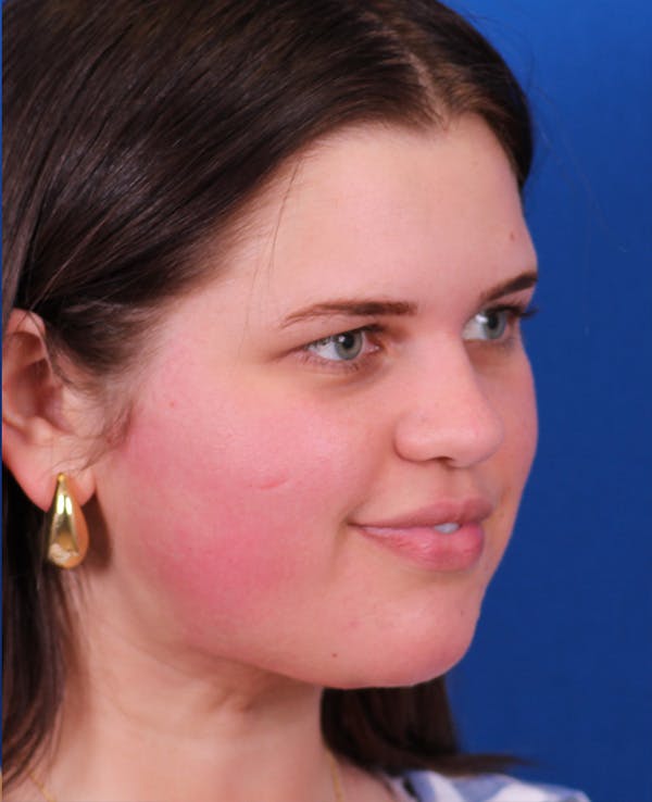Neck deFINE Before & After Gallery - Patient 331285 - Image 2