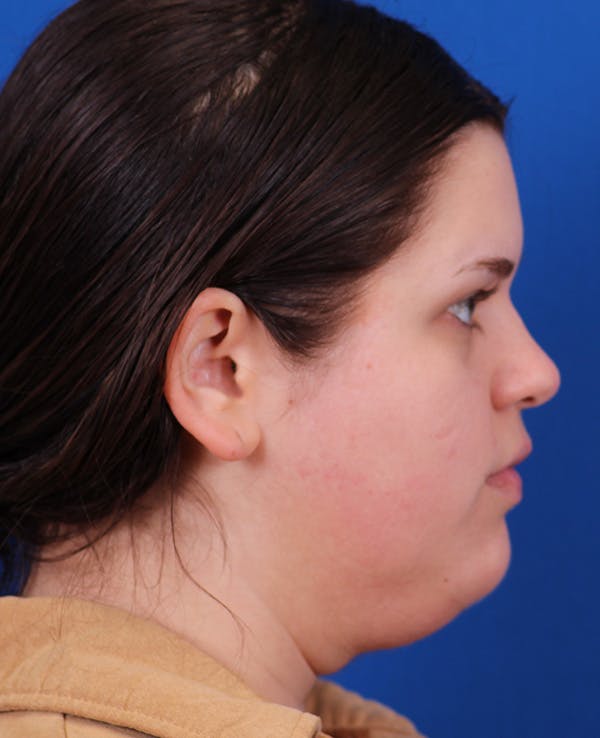 Neck deFINE Before & After Gallery - Patient 331285 - Image 7