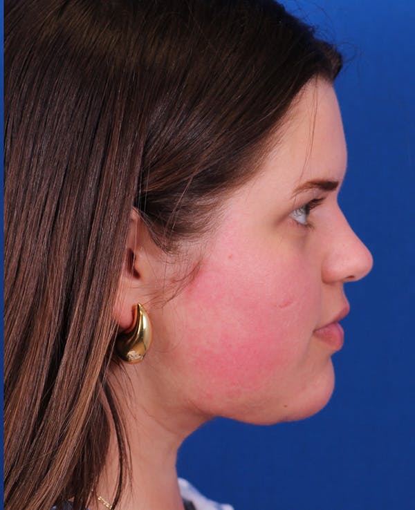 Neck deFINE Before & After Gallery - Patient 331285 - Image 8