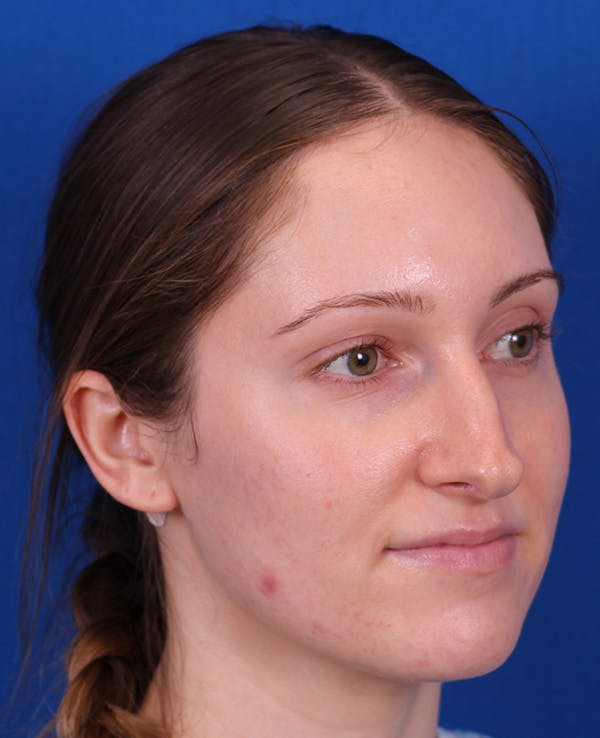 Rhinoplasty Before & After Gallery - Patient 103371 - Image 3
