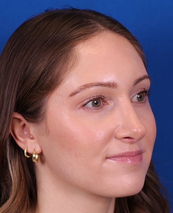 Rhinoplasty Before & After Gallery - Patient 103371 - Image 4