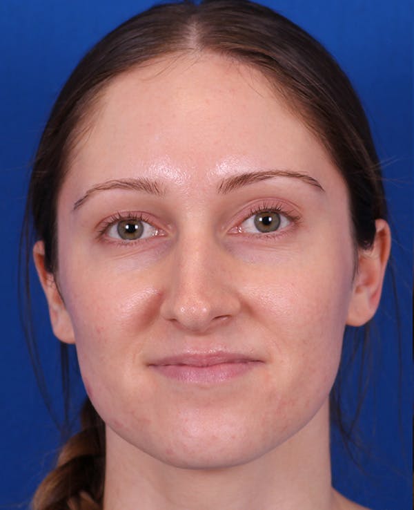 Rhinoplasty Before & After Gallery - Patient 103371 - Image 5