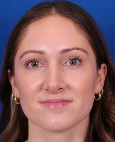 Rhinoplasty Before & After Gallery - Patient 103371 - Image 6