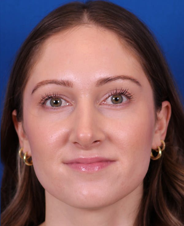 Rhinoplasty Before & After Gallery - Patient 103371 - Image 6