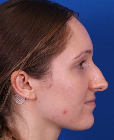 Rhinoplasty Before & After Gallery - Patient 103371 - Image 1