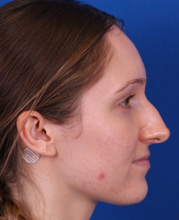 Rhinoplasty Before & After Gallery - Patient 103371 - Image 1