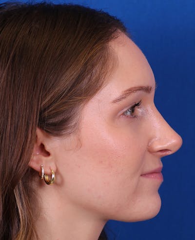 Rhinoplasty Before & After Gallery - Patient 103371 - Image 2