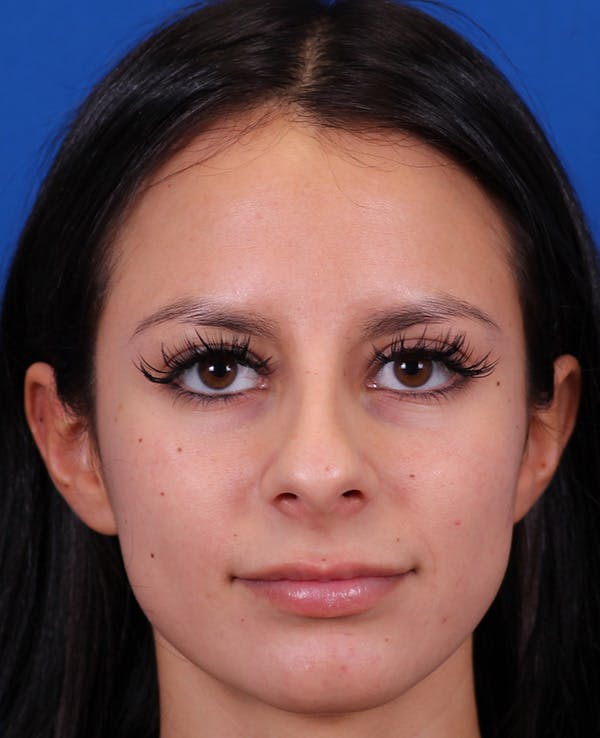 Rhinoplasty Before & After Gallery - Patient 710100 - Image 5