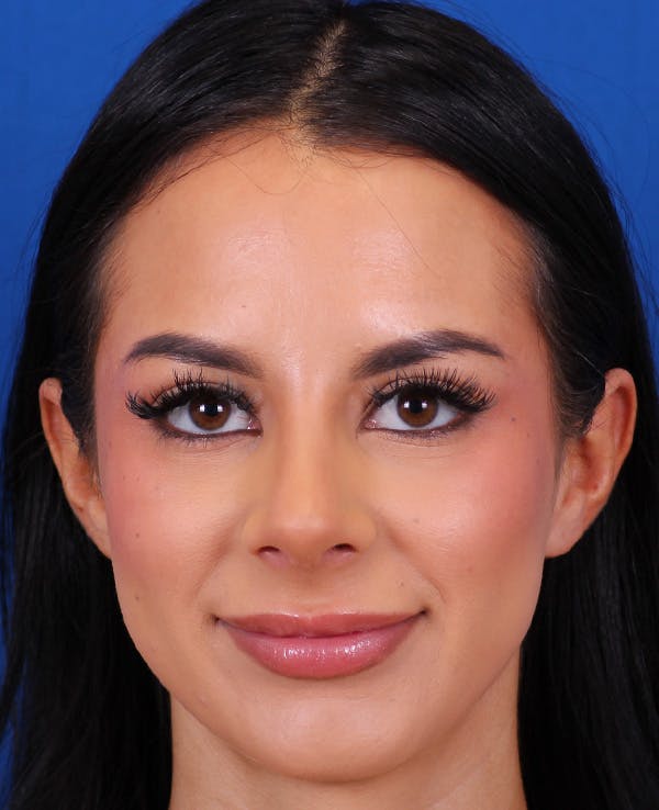 Rhinoplasty Before & After Gallery - Patient 710100 - Image 6