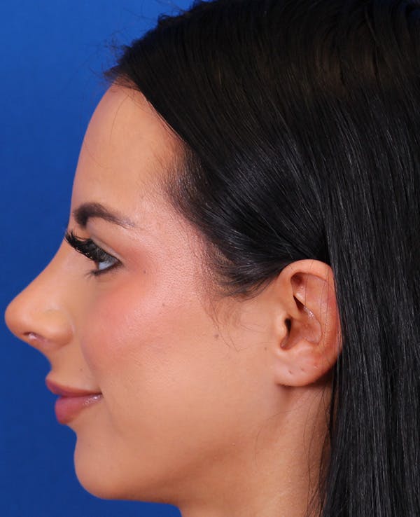 Rhinoplasty Before & After Gallery - Patient 710100 - Image 2
