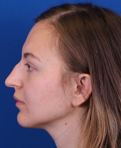 Rhinoplasty Before & After Gallery - Patient 348418 - Image 1