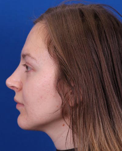 Rhinoplasty Before & After Gallery - Patient 348418 - Image 2