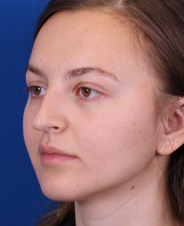 Rhinoplasty Before & After Gallery - Patient 348418 - Image 3