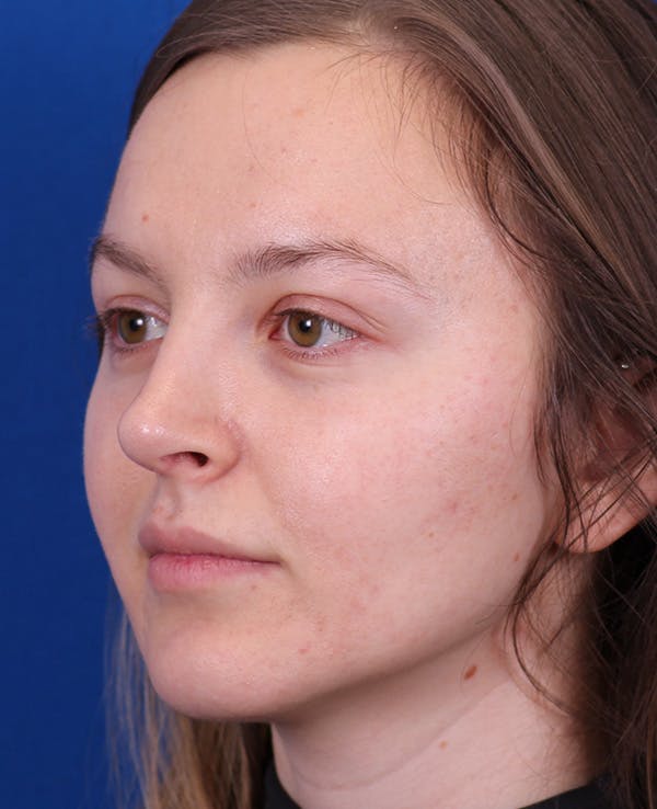 Rhinoplasty Before & After Gallery - Patient 348418 - Image 4