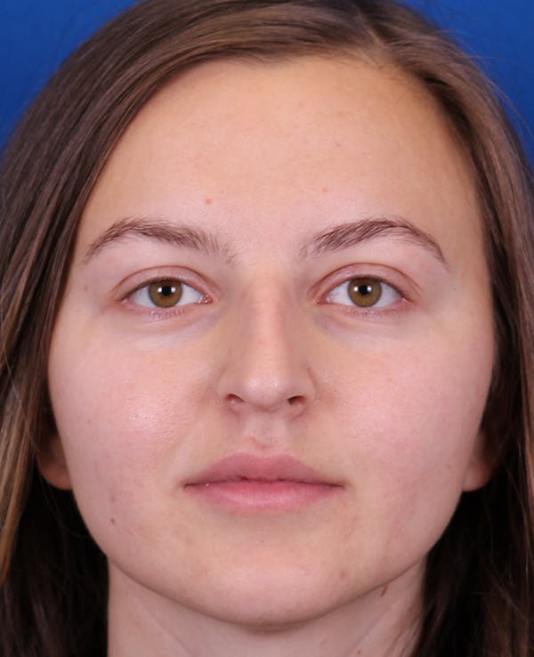Rhinoplasty Before & After Gallery - Patient 348418 - Image 5
