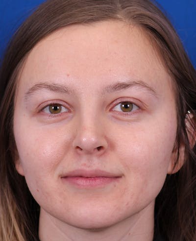 Rhinoplasty Before & After Gallery - Patient 348418 - Image 6