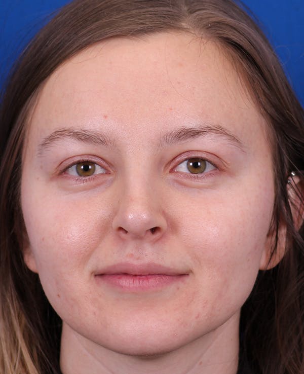 Rhinoplasty Before & After Gallery - Patient 348418 - Image 6