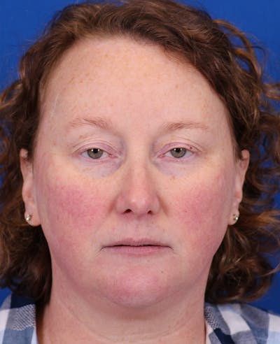 Facelift/Neck Lift Before & After Gallery - Patient 201370 - Image 1