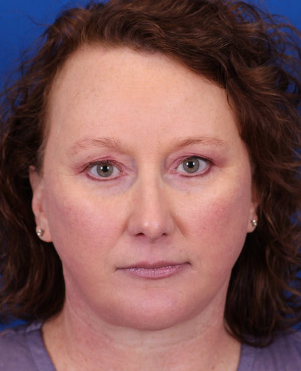 Facelift/Neck Lift Before & After Gallery - Patient 201370 - Image 2