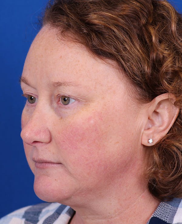 Facelift/Neck Lift Before & After Gallery - Patient 201370 - Image 3