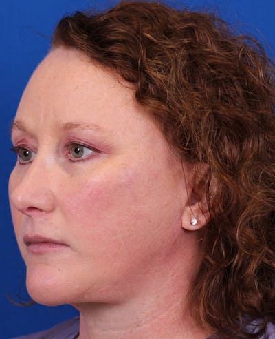 Facelift/Neck Lift Before & After Gallery - Patient 201370 - Image 4