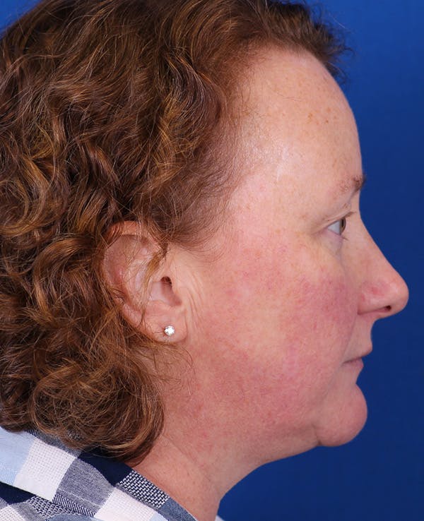 Facelift/Neck Lift Before & After Gallery - Patient 201370 - Image 5