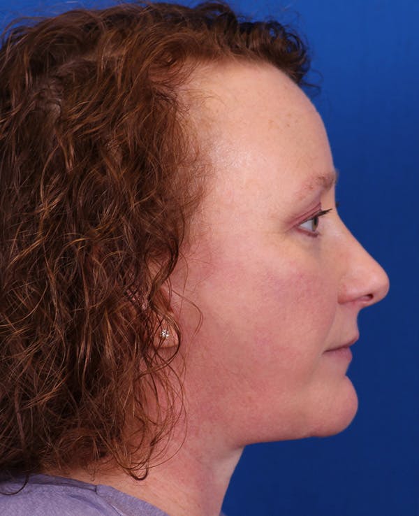 Facelift/Neck Lift Before & After Gallery - Patient 201370 - Image 6