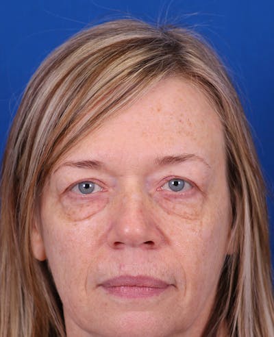 Blepharoplasty Before & After Gallery - Patient 356396 - Image 1