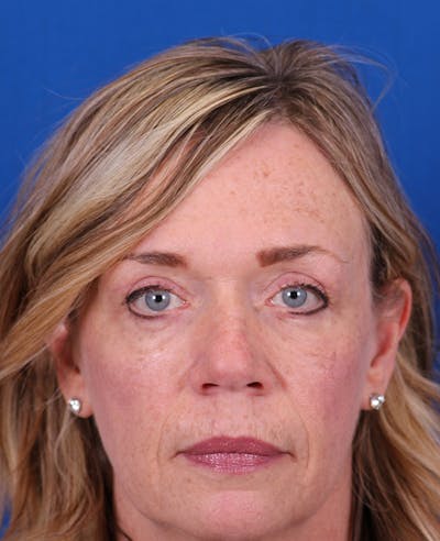 Blepharoplasty Before & After Gallery - Patient 356396 - Image 2