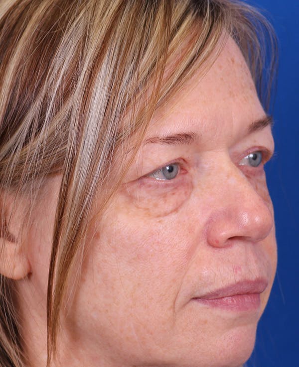 Blepharoplasty Before & After Gallery - Patient 356396 - Image 3