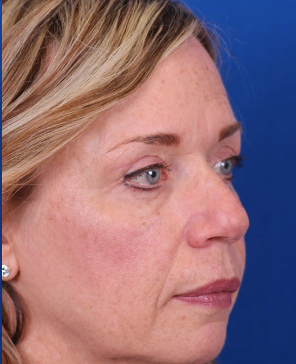 Blepharoplasty Before & After Gallery - Patient 356396 - Image 4