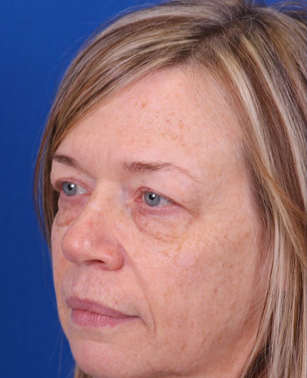 Blepharoplasty Before & After Gallery - Patient 356396 - Image 5