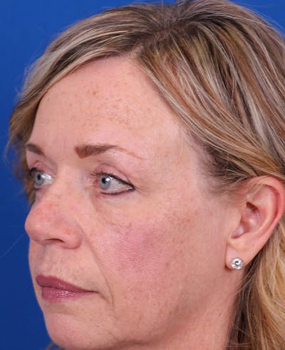 Blepharoplasty Before & After Gallery - Patient 356396 - Image 6