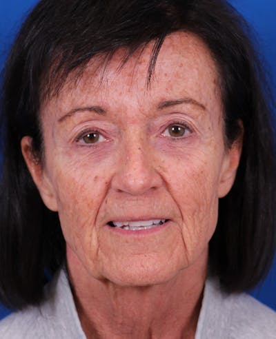 Facelift/Neck Lift Before & After Gallery - Patient 314351 - Image 1