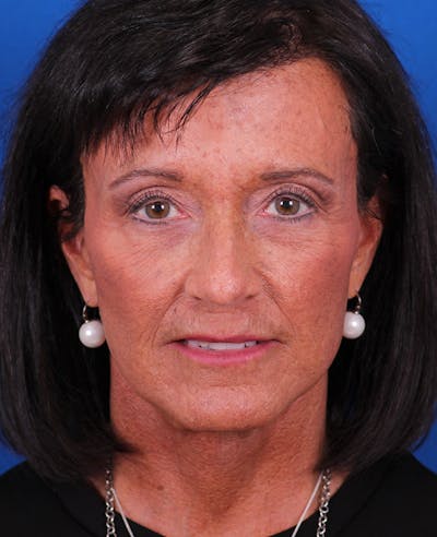 Facelift/Neck Lift Before & After Gallery - Patient 314351 - Image 2
