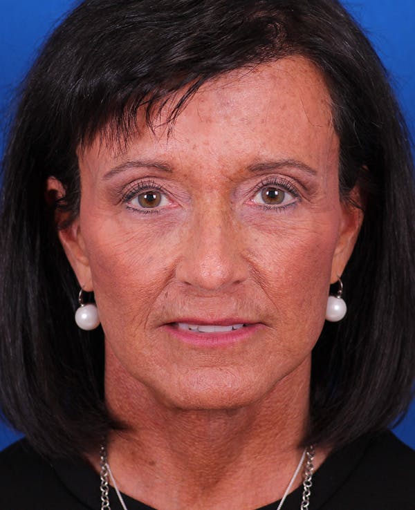 Facelift/Neck Lift Before & After Gallery - Patient 314351 - Image 2