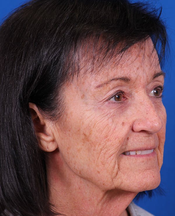 Facelift/Neck Lift Before & After Gallery - Patient 314351 - Image 3