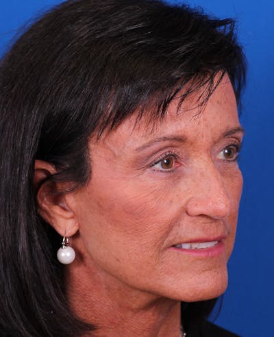 Facelift/Neck Lift Before & After Gallery - Patient 314351 - Image 4