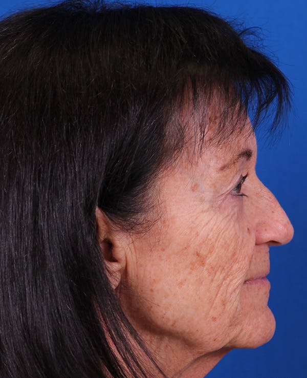Facelift/Neck Lift Before & After Gallery - Patient 314351 - Image 5
