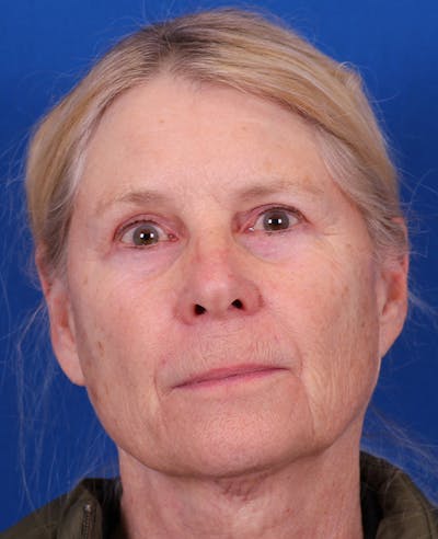 Facelift/Neck Lift Before & After Gallery - Patient 410337 - Image 1