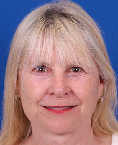 Facelift/Neck Lift Before & After Gallery - Patient 410337 - Image 2