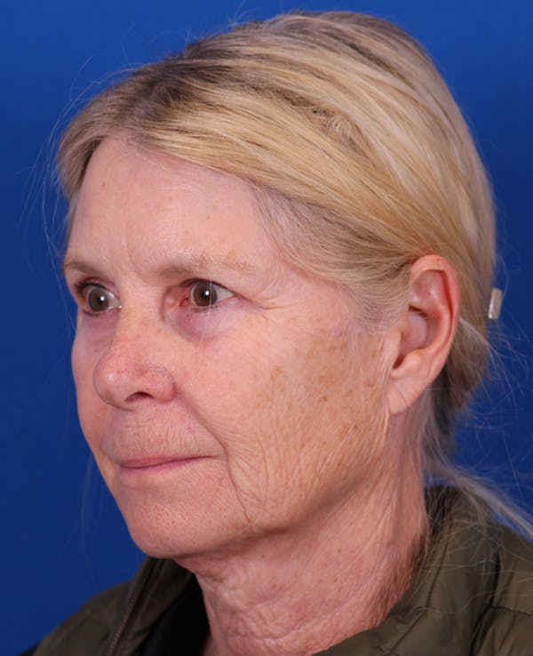Facelift/Neck Lift Before & After Gallery - Patient 410337 - Image 3