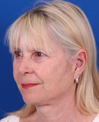 Facelift/Neck Lift Before & After Gallery - Patient 410337 - Image 4