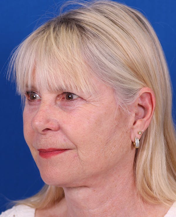 Facelift/Neck Lift Before & After Gallery - Patient 410337 - Image 4