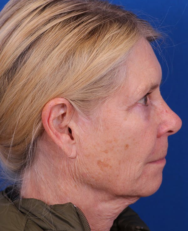 Facelift/Neck Lift Before & After Gallery - Patient 410337 - Image 5