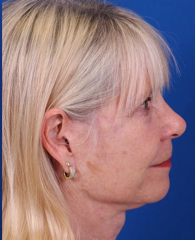 Facelift/Neck Lift Before & After Gallery - Patient 410337 - Image 6