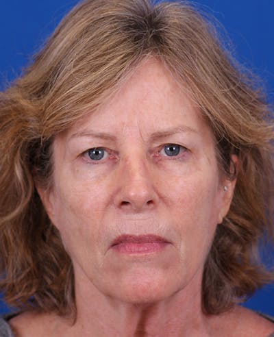 Facelift/Neck Lift Before & After Gallery - Patient 200239 - Image 1