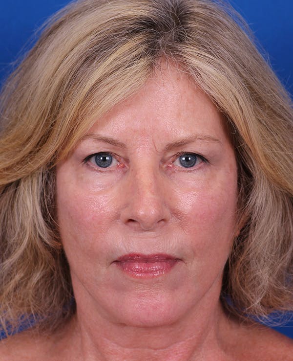 Facelift/Neck Lift Before & After Gallery - Patient 200239 - Image 2