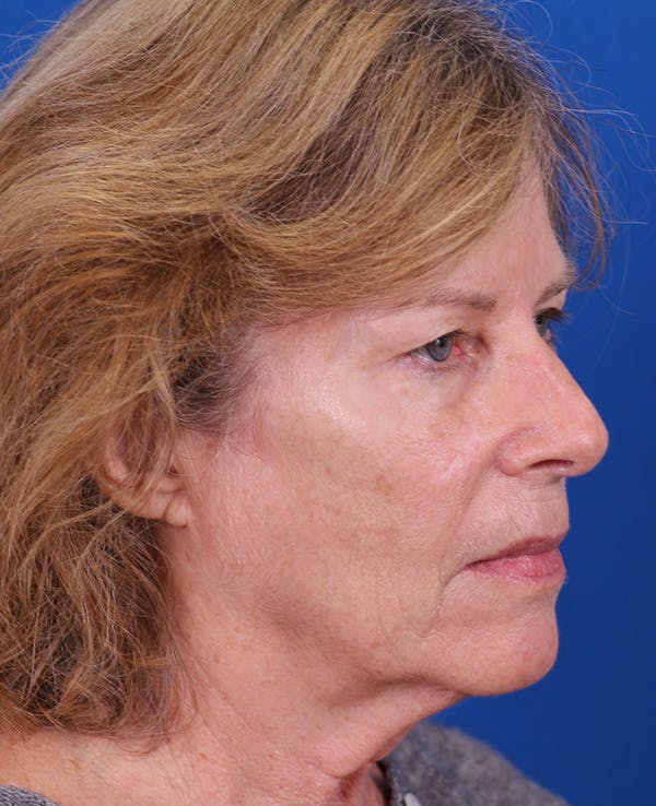 Facelift/Neck Lift Before & After Gallery - Patient 200239 - Image 3