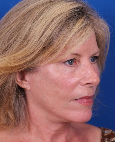 Facelift/Neck Lift Before & After Gallery - Patient 200239 - Image 4